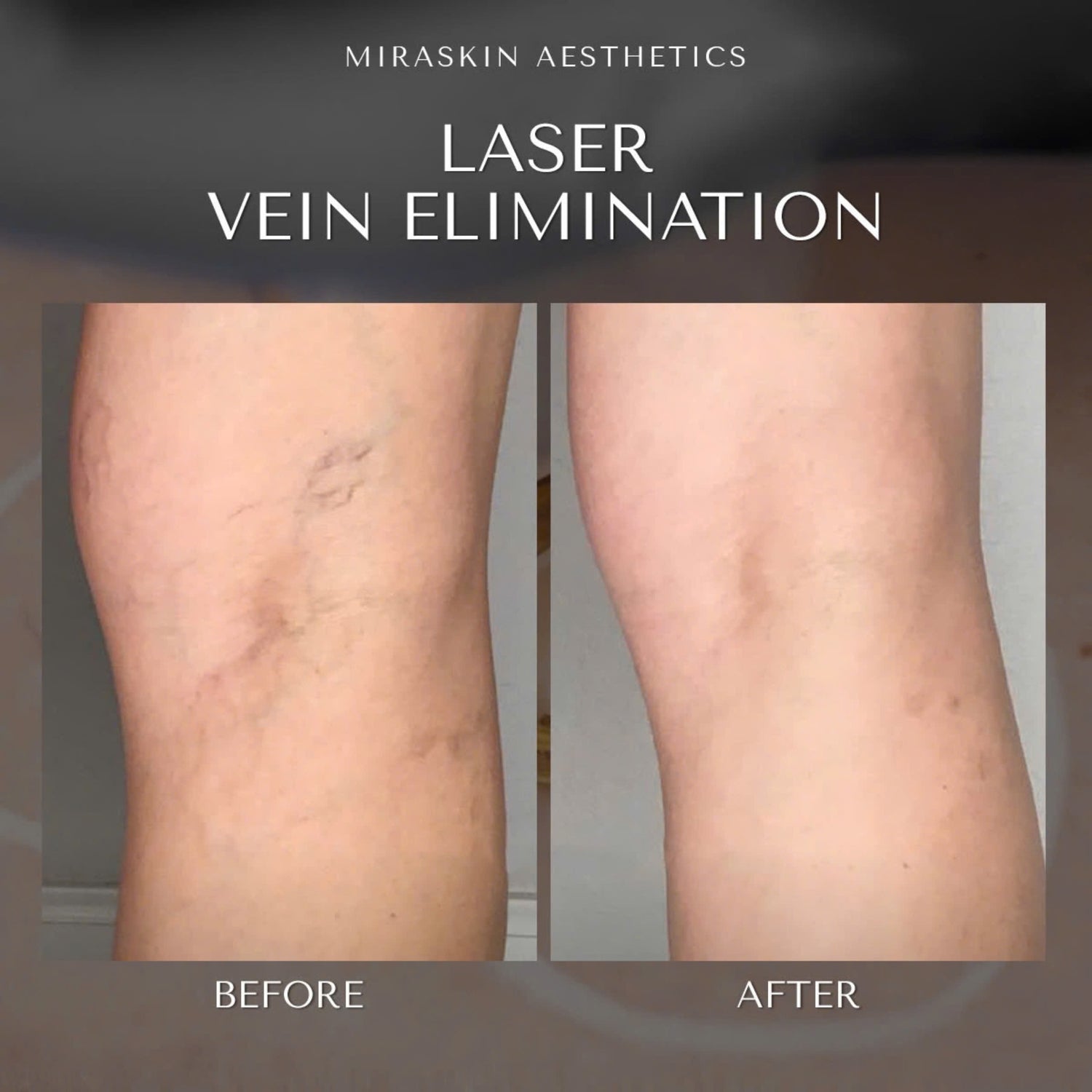 Vein Elimination