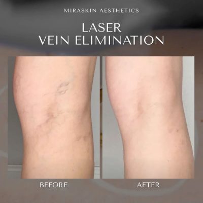 vein-banner vein-banner